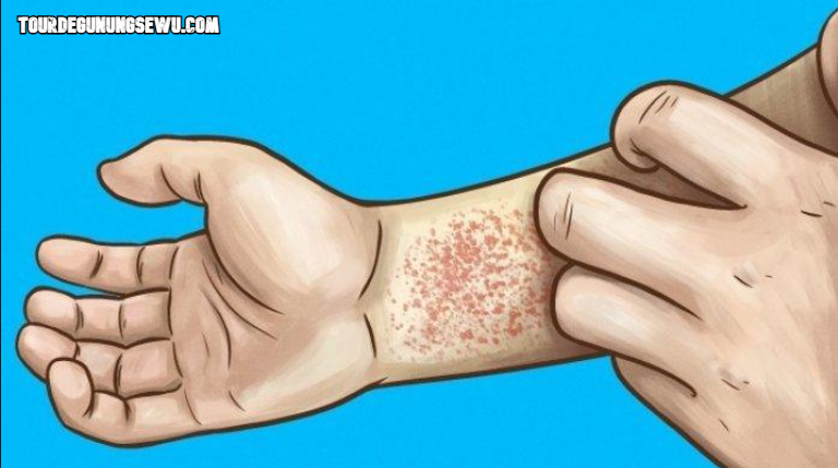 Cara Mencegah Terkena Alergi Kulit: Jangan Sampai Kulitmu Jadi Korban!